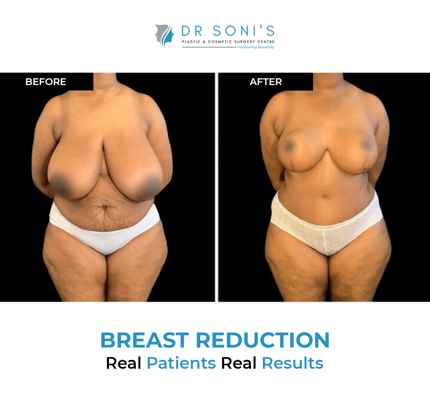 Breast Reduction Surgery can change everything in a day! - Plastic